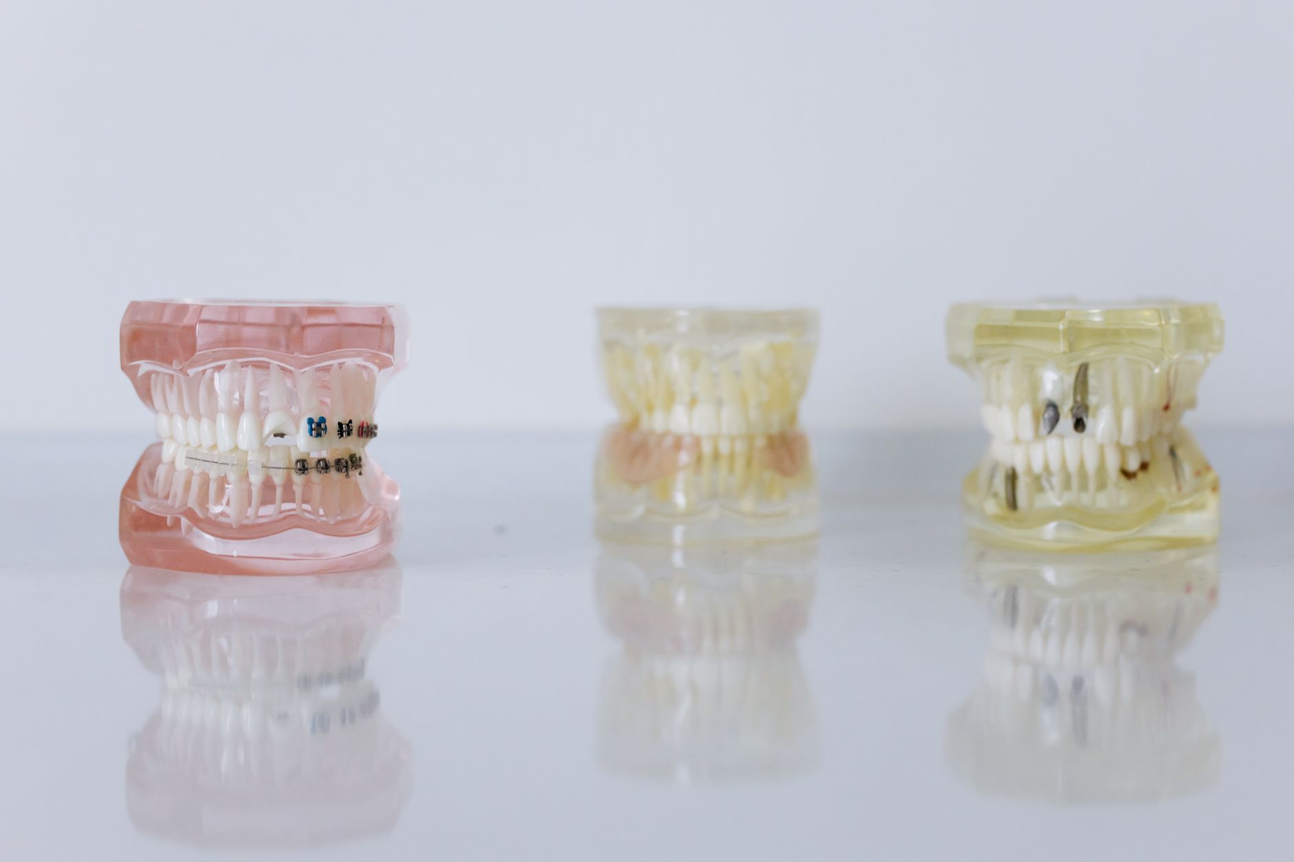 Exploring the Differences Between Invisalign and Braces