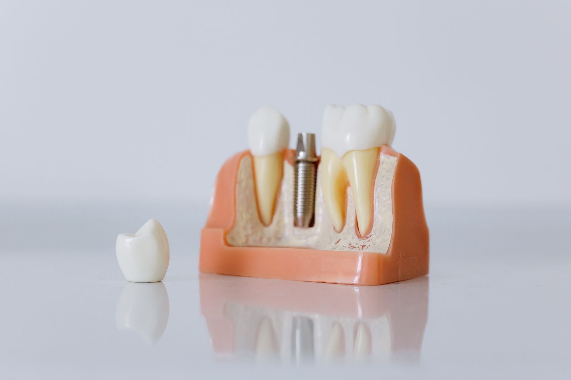 How to Prepare for Dental Implant Surgery: A Practical Guide