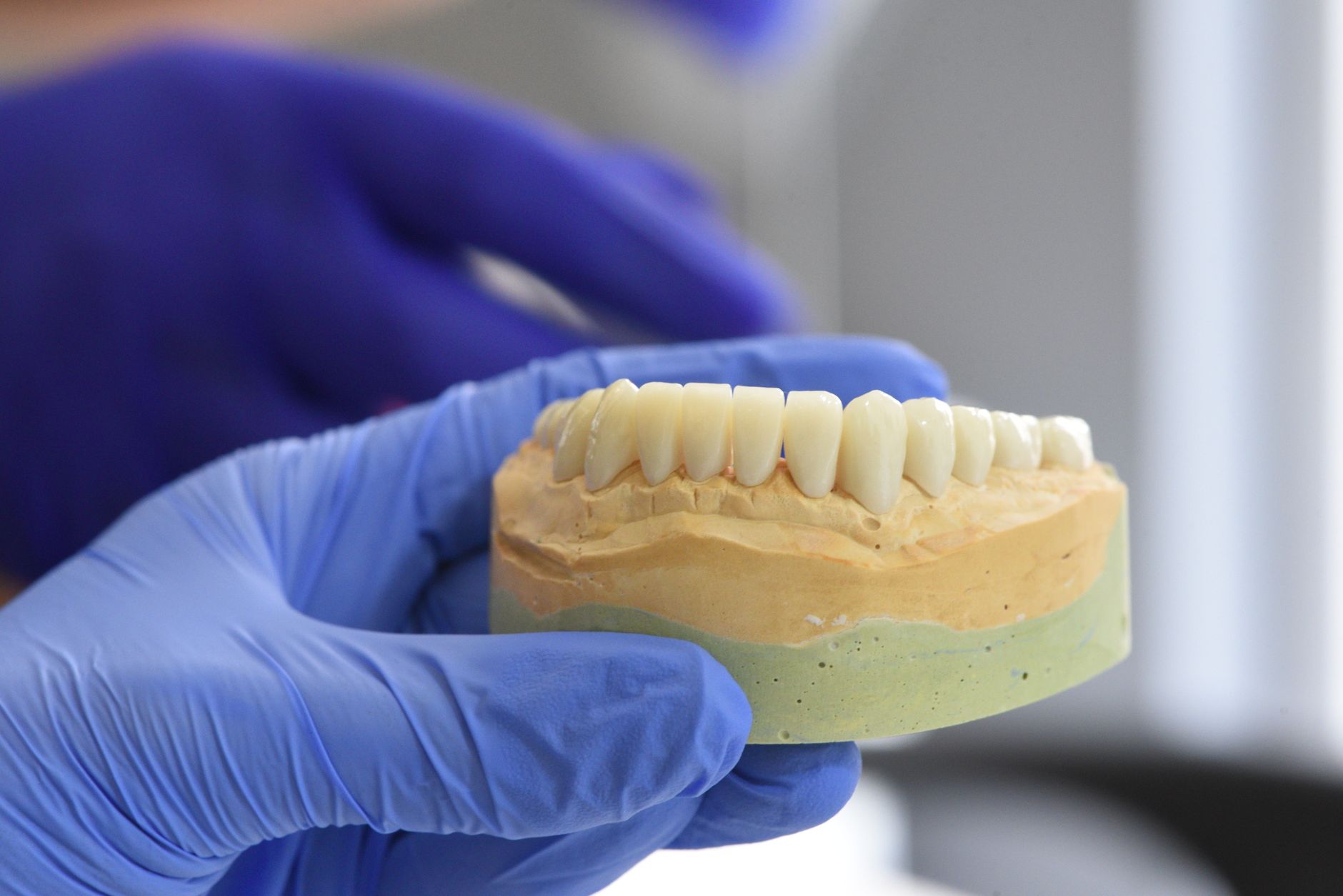 What Are Mini Dental Implants? A Compact Solution for Tooth Replacement