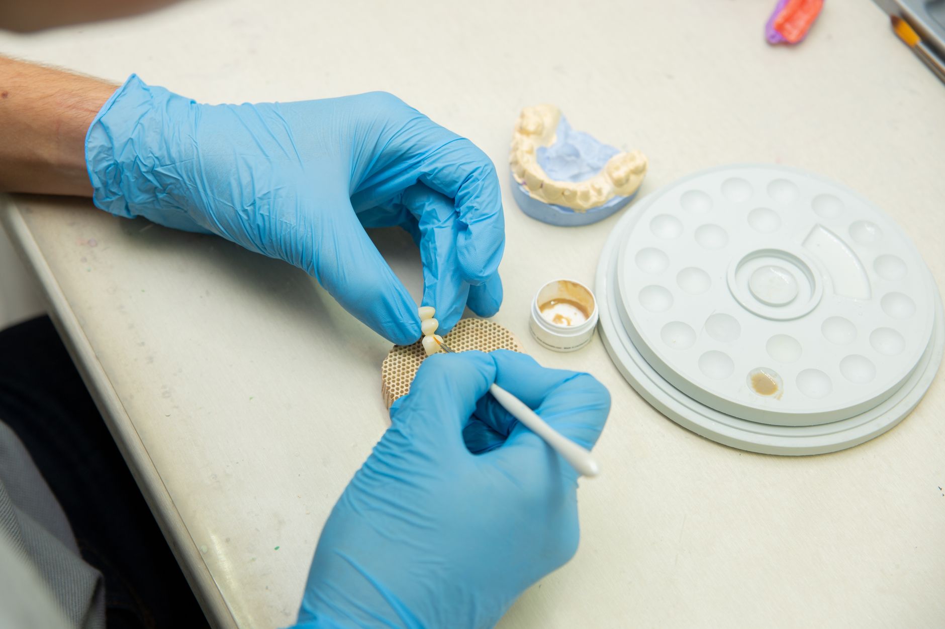 What to Expect After All on 4 Dental Implant Surgery